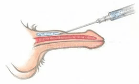 Injecții cu acid hialuronic